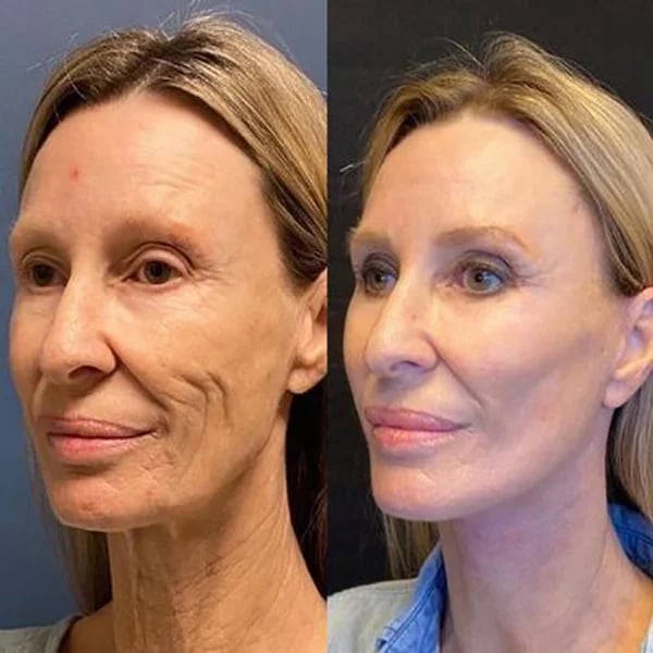 "The Botox" jauninatis veido serumas